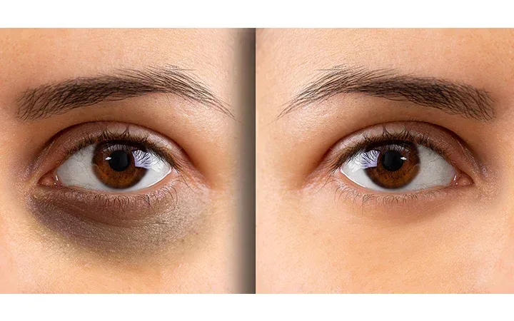 डार्क सर्कल्स से परेशान हैं? अपनाएं ये आसान डाइट और लाइफस्टाइल टिप्स, रिजल्ट देखकर रह जाएंगे हैरान